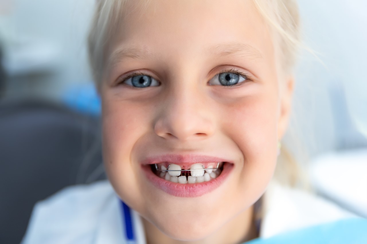 losse beugel - Orthodontiepraktijk in Alkmaar